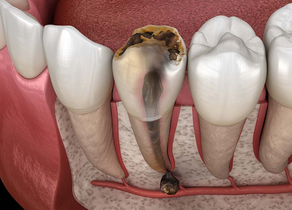 Dental-Cyst